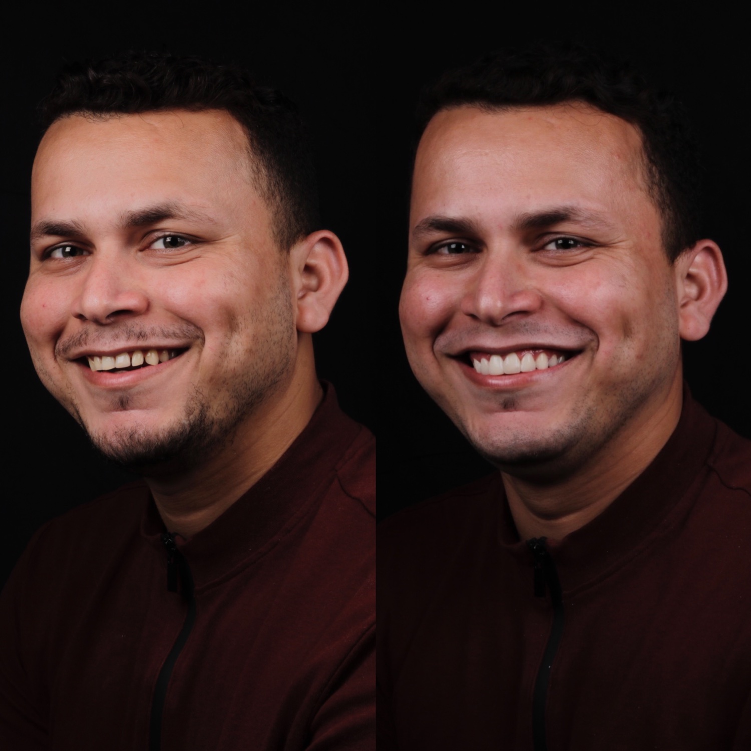 Antes e depois de facetas, Dr. Pedro Campêlo — inclinic