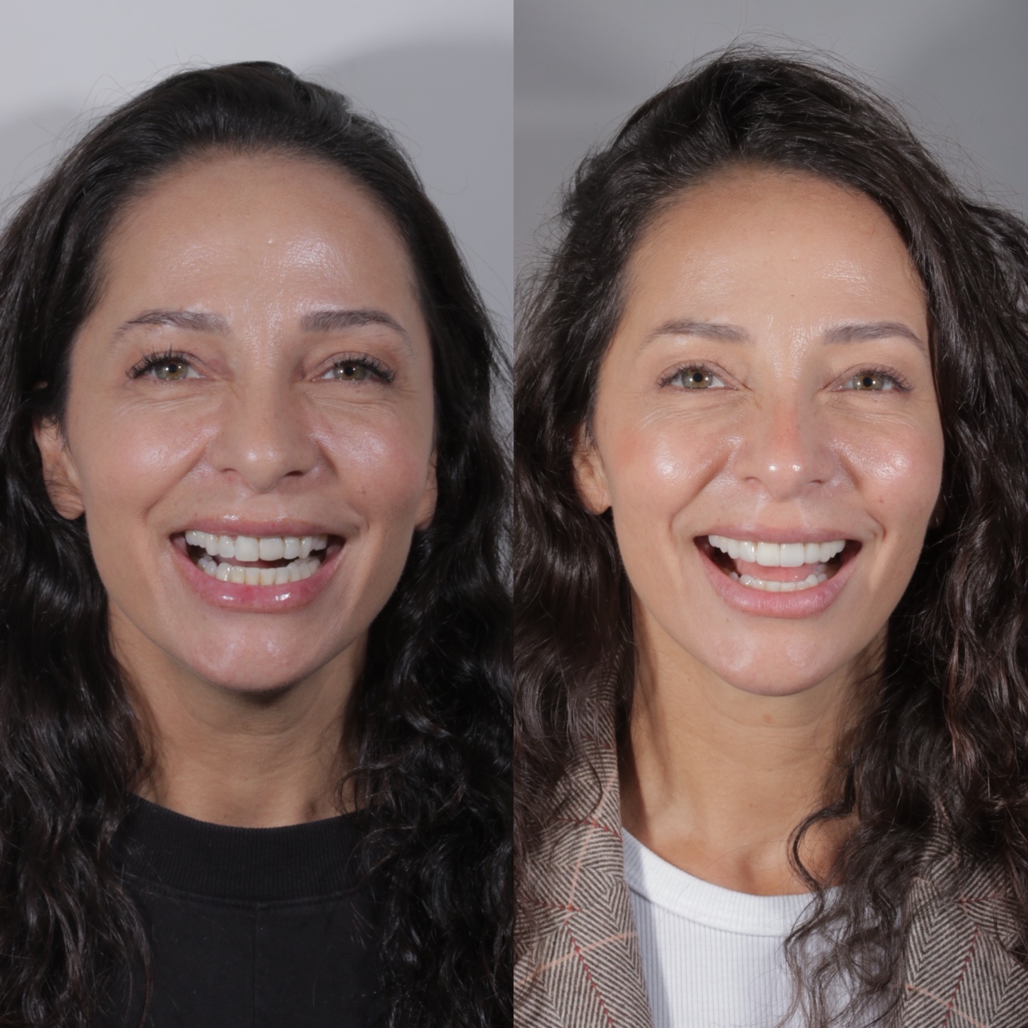 Antes e depois de reabilitação estética do sorriso, Dr. Pedro Campêlo — inclinic