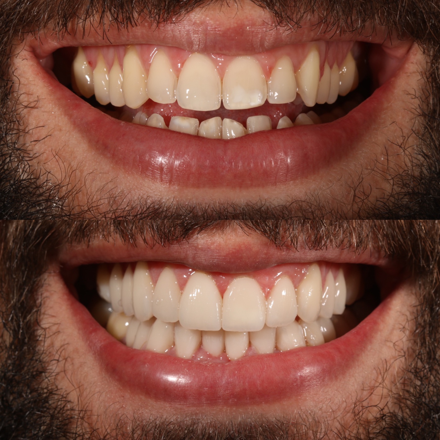 Antes e depois de lentes de contato dental, close do sorriso, na inclinic